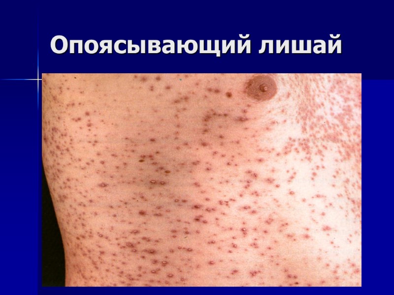 Опоясывающий лишай